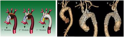 Hemodynamic numerical simulation of aortic arch modular inner branched stent-graft in eight early patients from the first-in-human case series